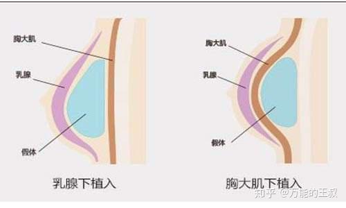 植入进胸部的假体,到底埋伏在哪儿的?新结交的男朋友能mo出来吗?