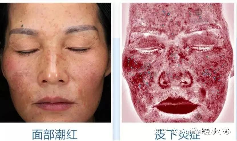 原来明星也会换季丑又到了敏感肌历劫时