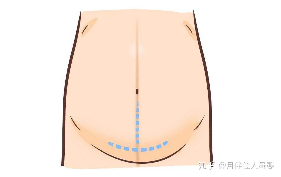 剖宫产新妈妈护理注意事项