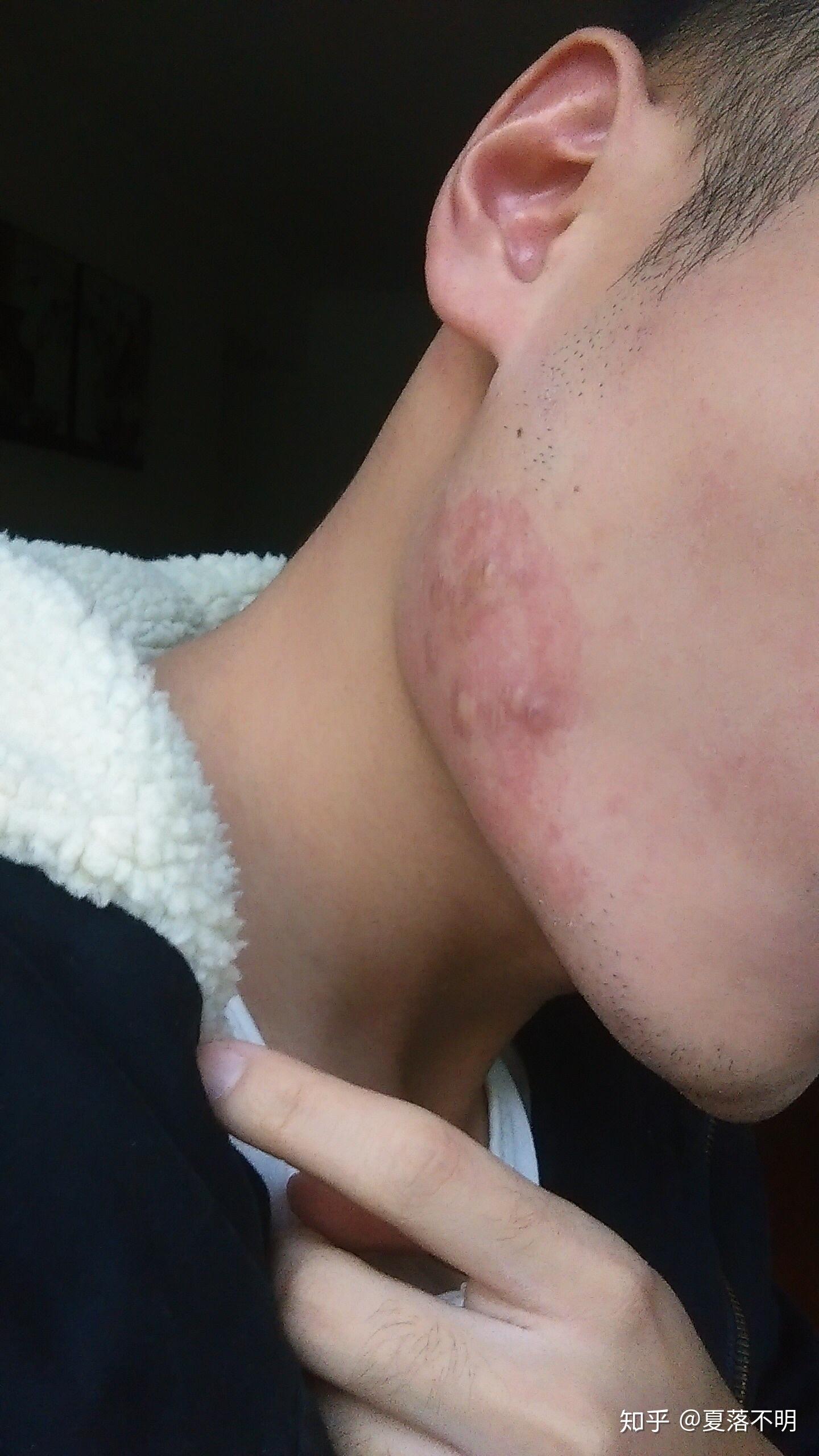 脸部疤痕疙瘩的治疗过程及走过的弯路给各位以借鉴吧