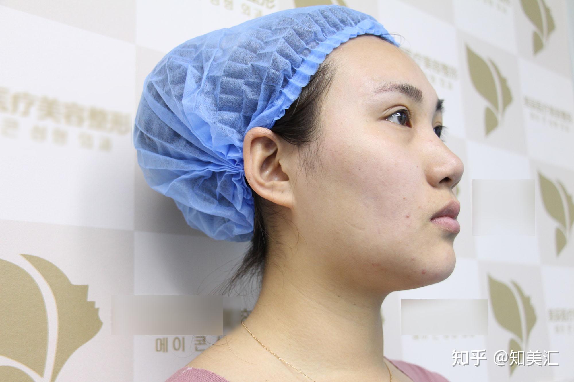 硅胶隆鼻的整形历程韩式生科三段假体第0天