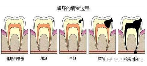 有蛀牙還可以做牙齒矯正嗎齲齒的發展過程是什麼