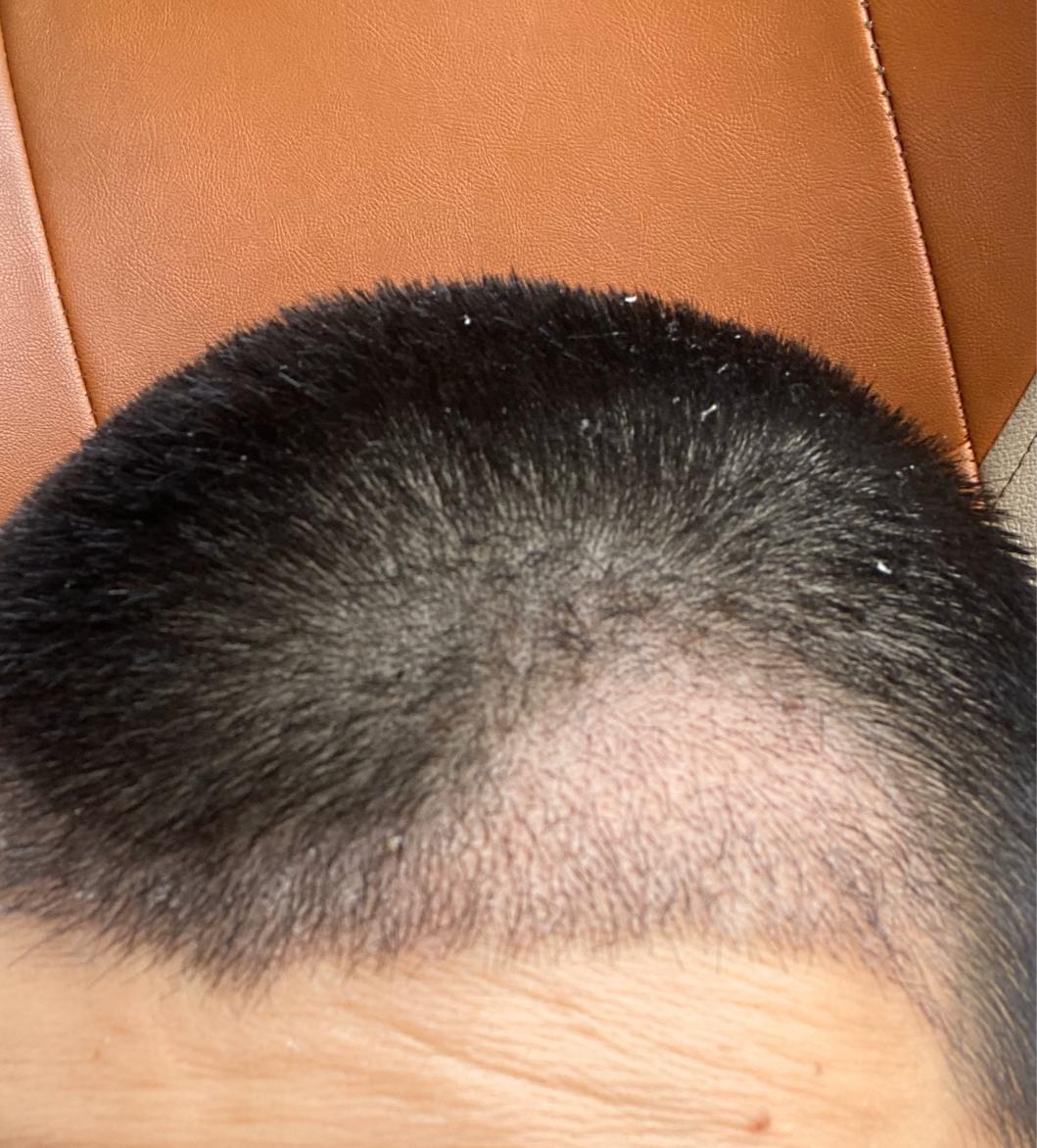 植发多久能变密发(植发多久会进入脱落)
