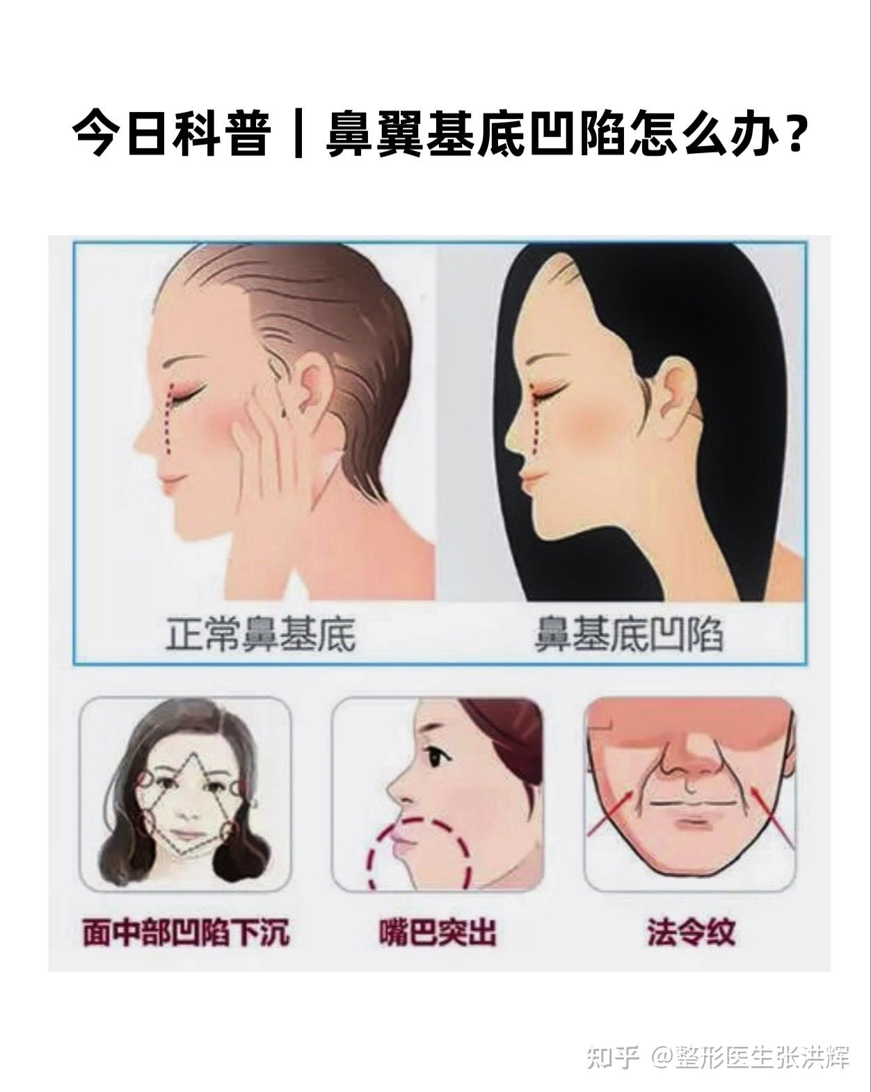 鼻翼基底凹陷的原因如何解决