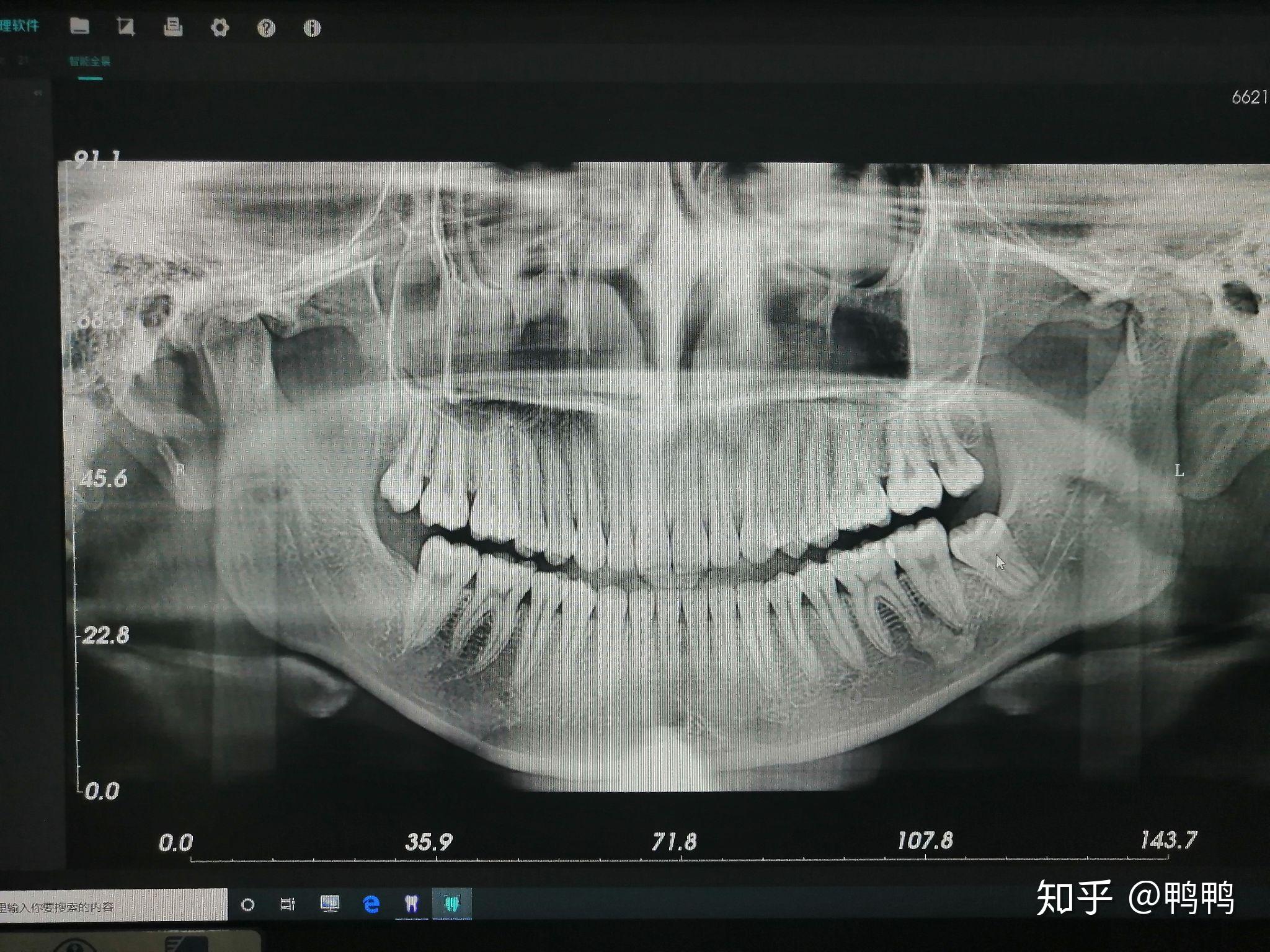 hpv口腔早期症状图片,感染hpv舌头两侧图 - 伤感说说吧