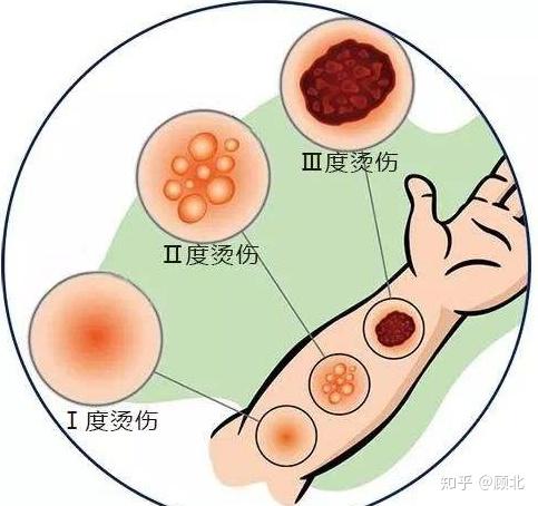 燙傷後怎樣做不留疤痕