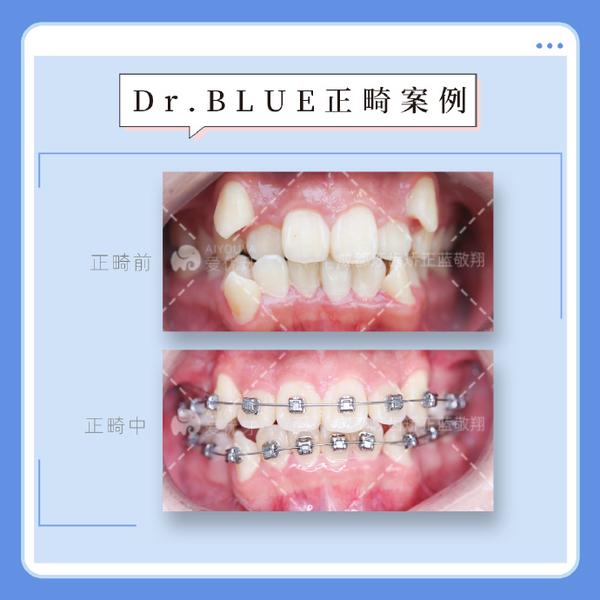 成都牙齿矫正|虎牙高位矫正案例 - 知乎