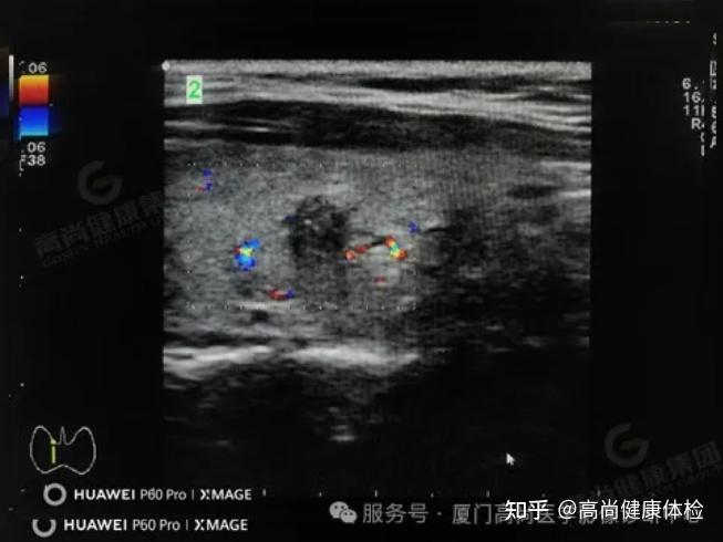 中年女老师经常生气时呼吸不畅超声诊断甲状腺癌