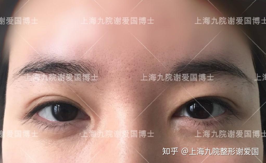 双眼皮术式:什么是park法? - 知乎