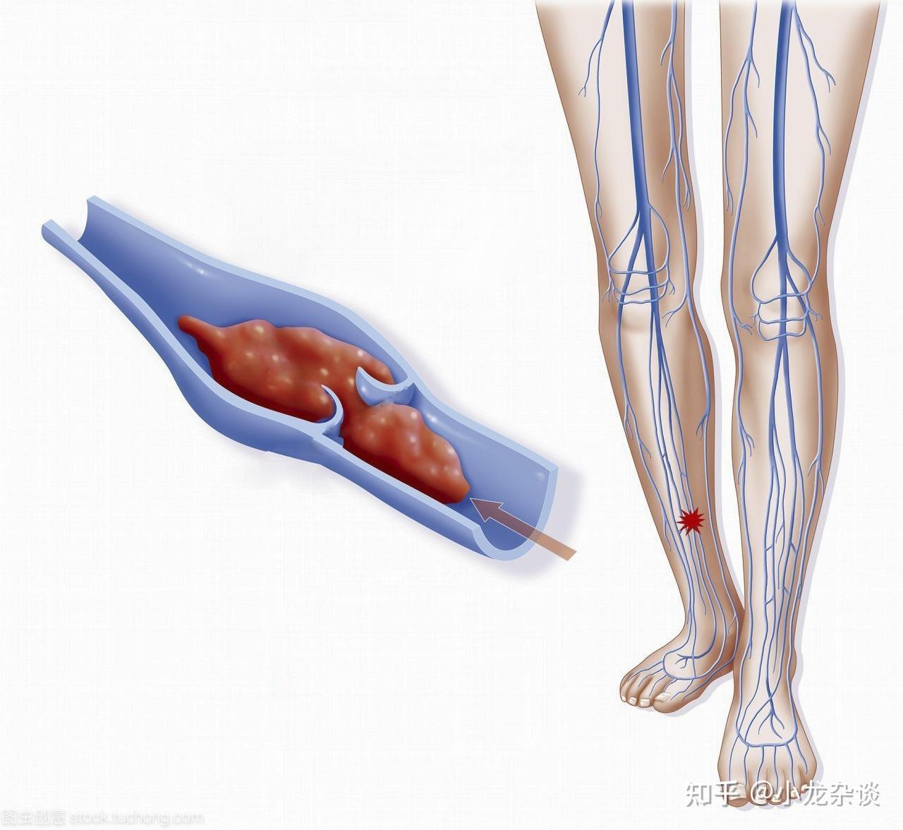血循环从下肢返回心脏主要通过站立行走,脚底的肌肉泵作用,使血液挤回