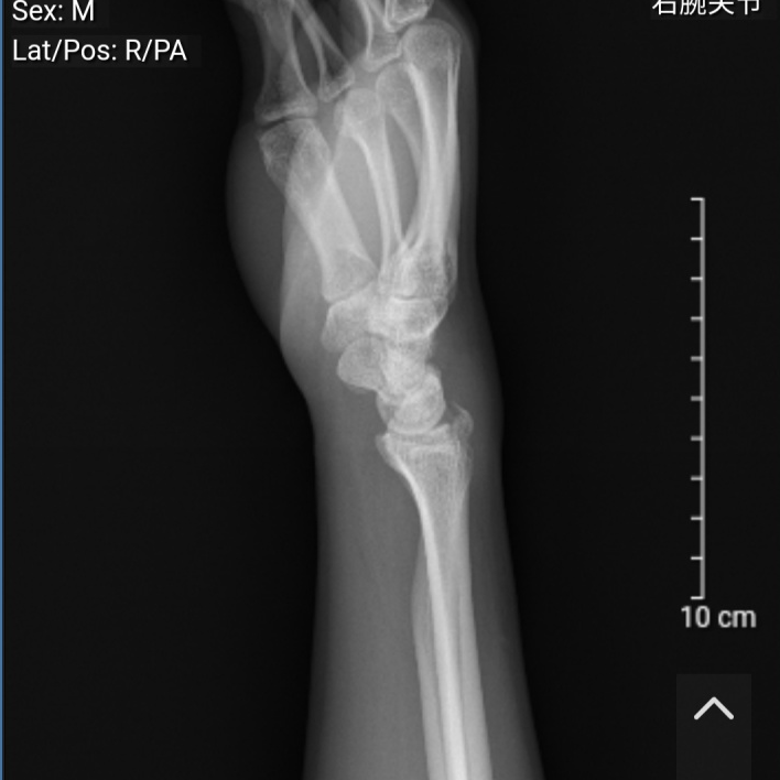 右手手腕舟状骨骨折愈合经历 知乎 右手手腕舟状骨骨折愈合经历 知乎