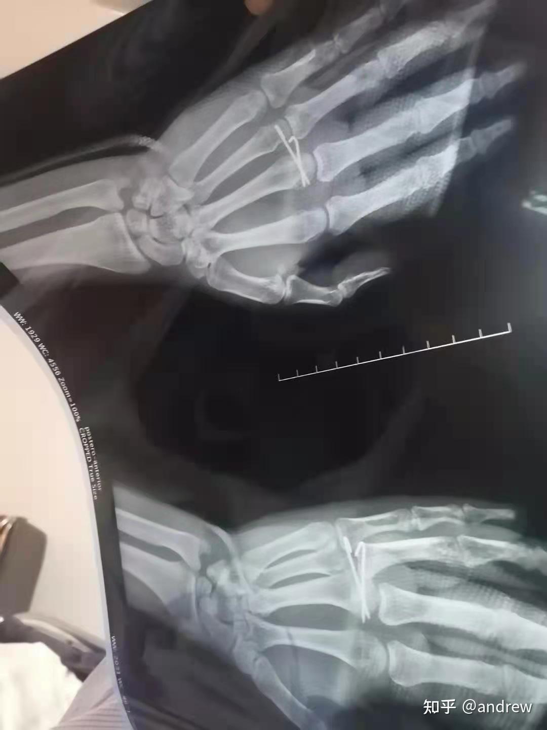 第三掌骨骨折恢复中