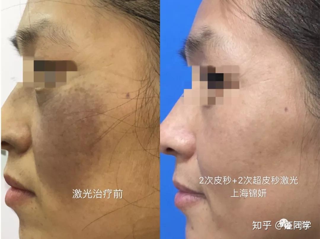 科普文记一类高概率治愈的胎记太田痣