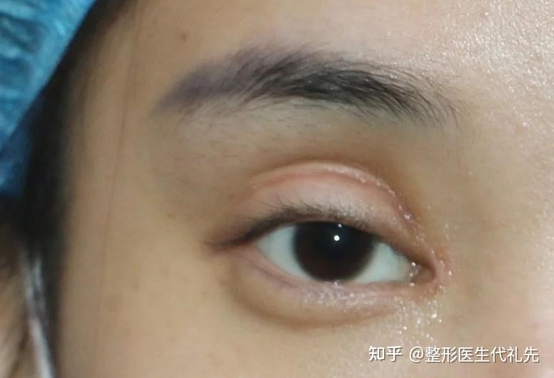 双眼皮上睑凹陷的原因和手术改善方式上睑凹陷的姐妹们来看看