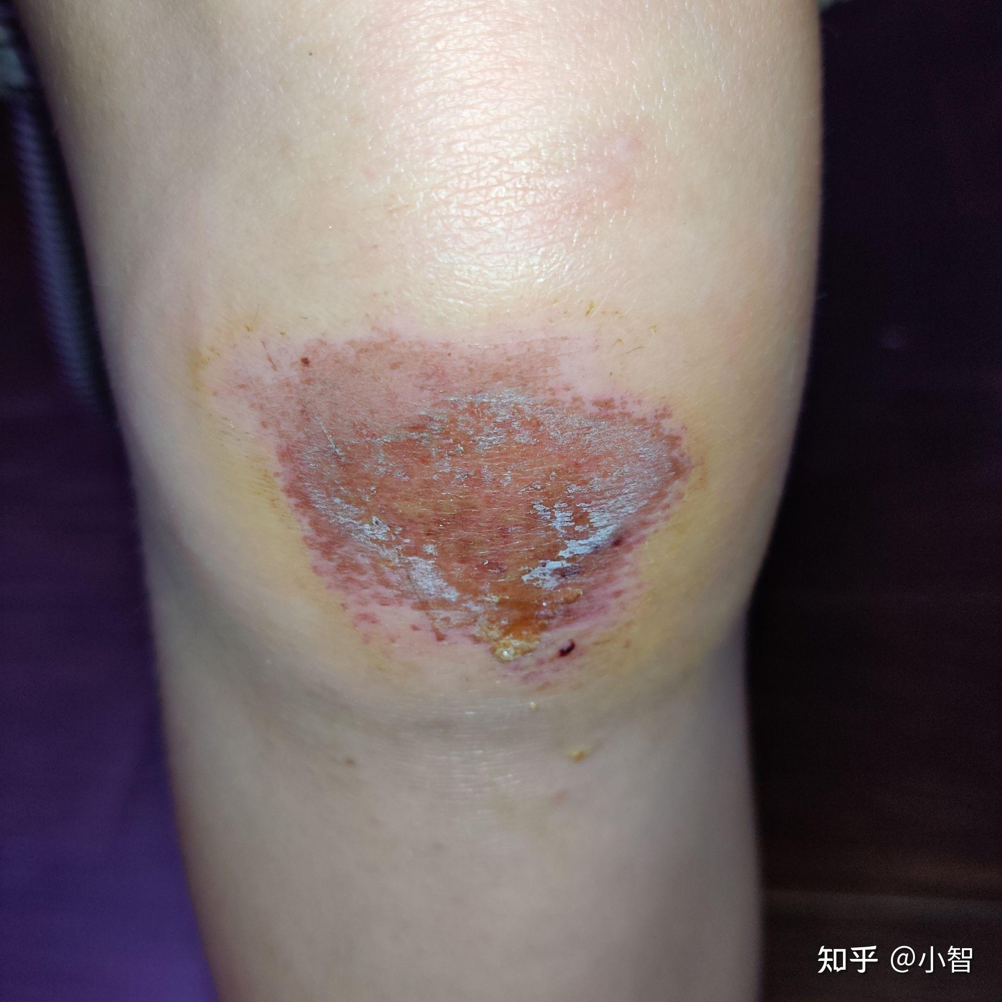 走路绊倒后膝盖摔破后每日记录