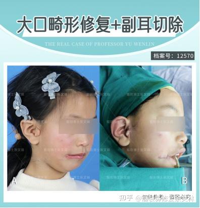 先天畸形不可怕,巧妙再造似天生! - 知乎