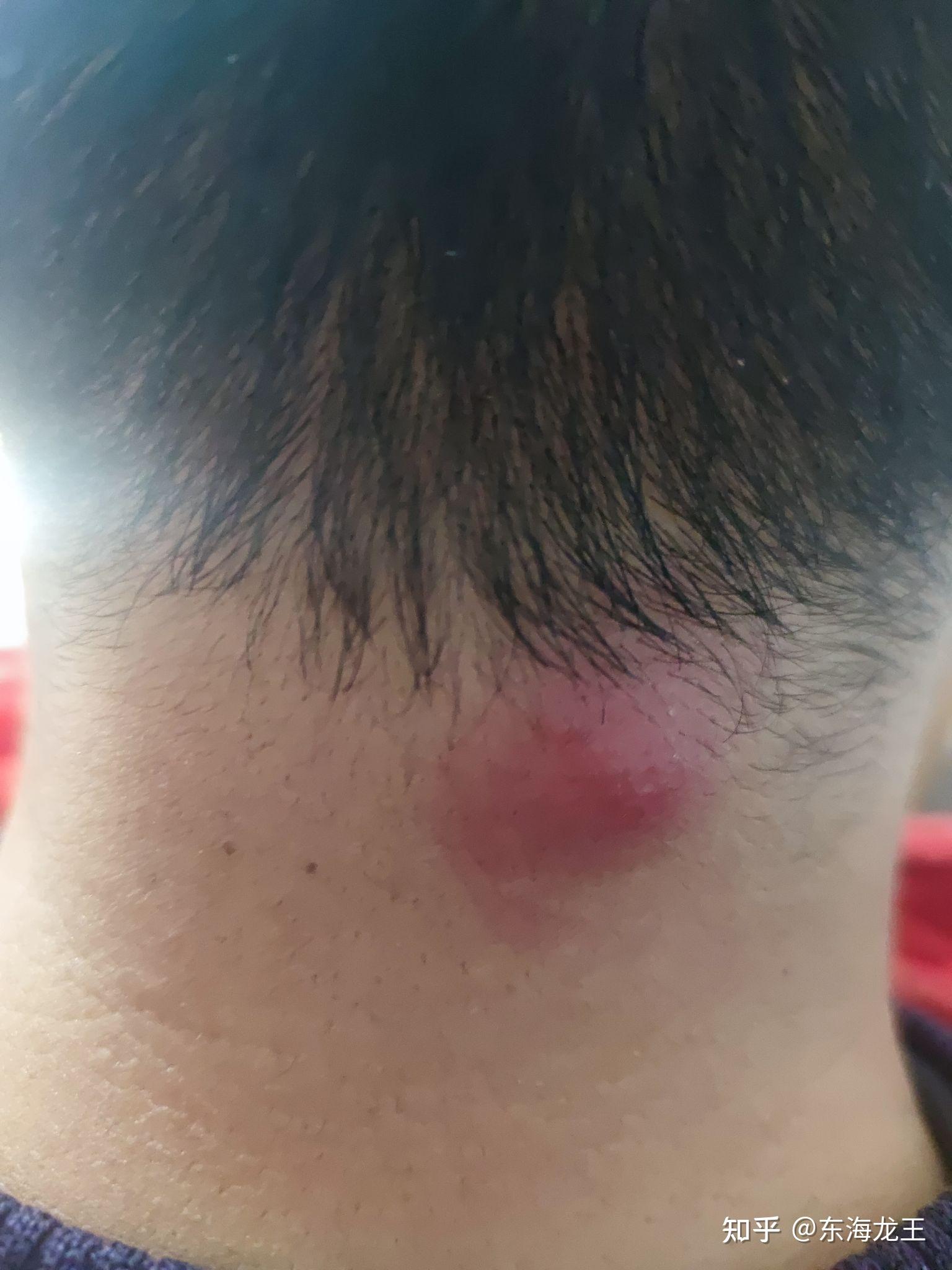 一次得痈的经历.