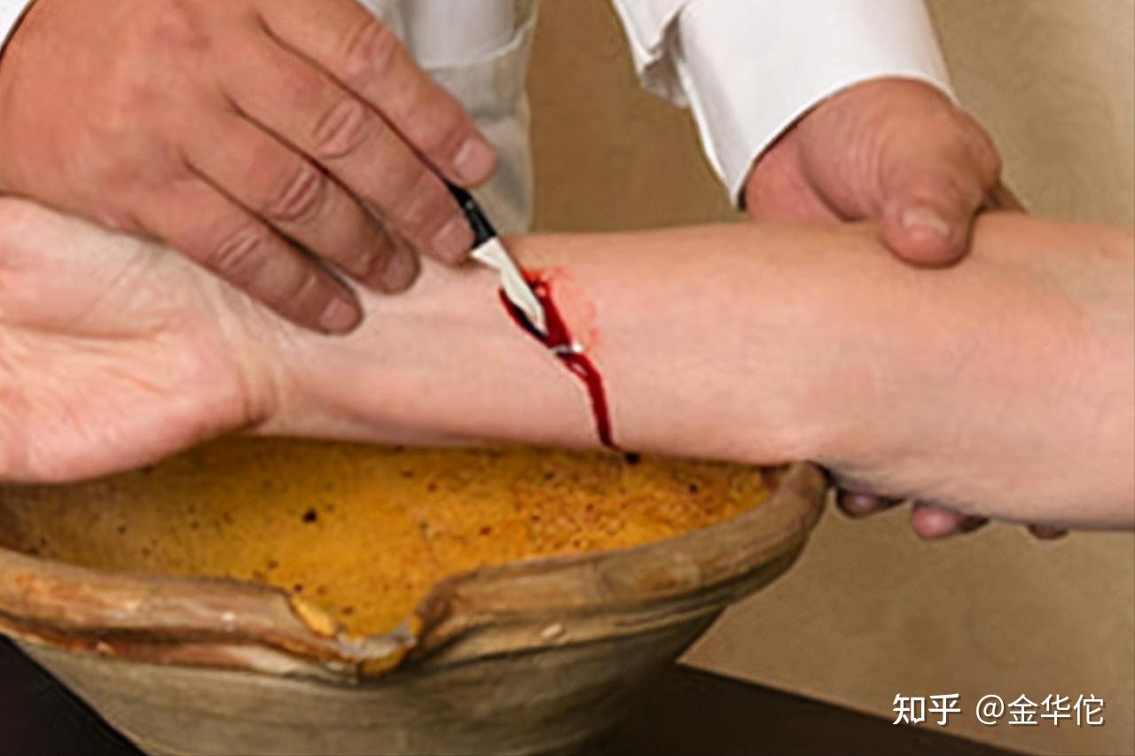 什么是中医放血疗法放血疗法有什么功效