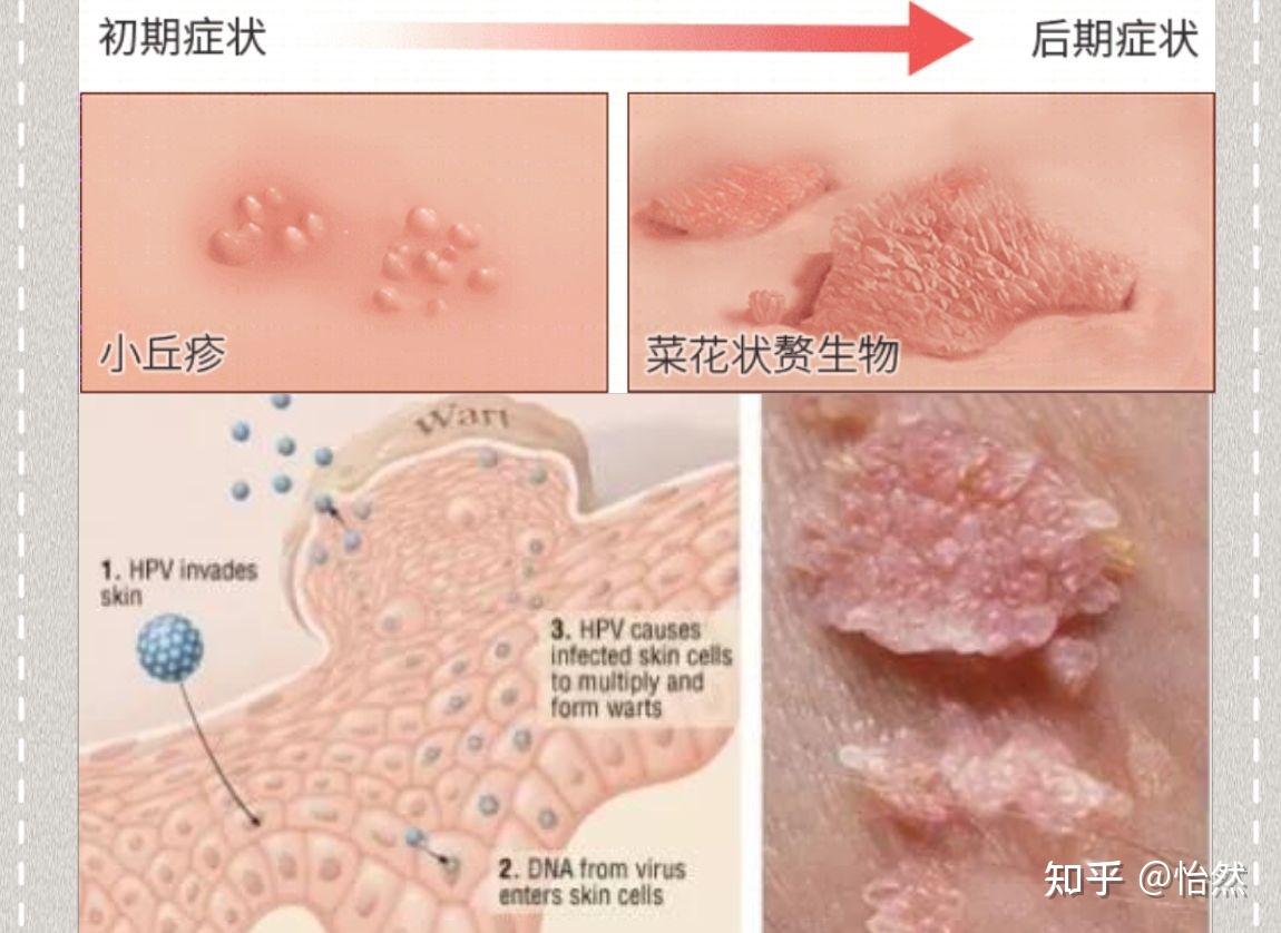 高危型hpv 初期图片