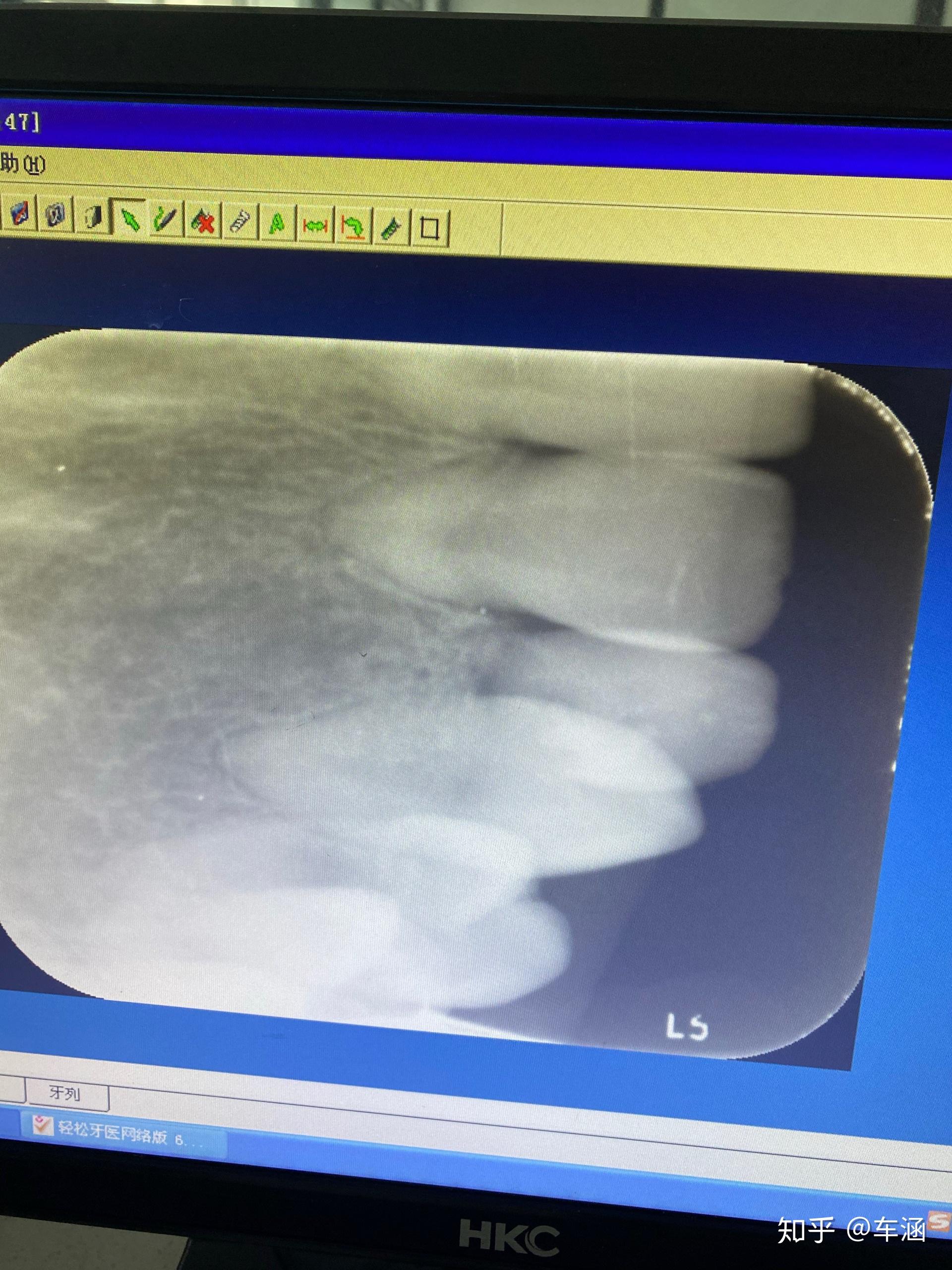正畸牙根短会有脱落风险不知发哦怎么抉择