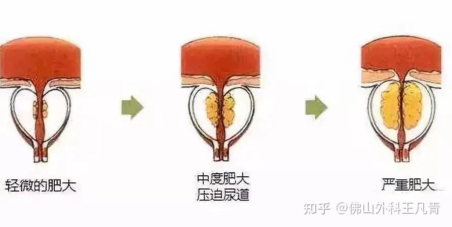 第二种是因为膀胱里面有细菌,细菌让膀胱发炎,炎症让膀胱壁肿大,就会