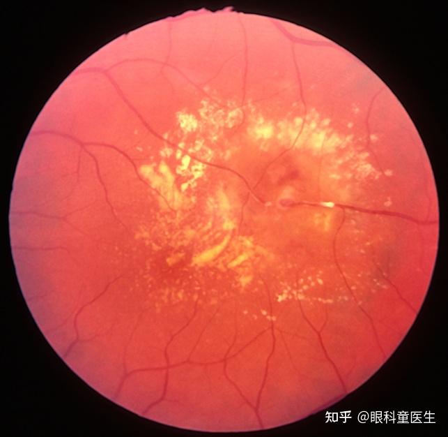 视网膜血管性疾病——6,获得性视网膜大动脉瘤