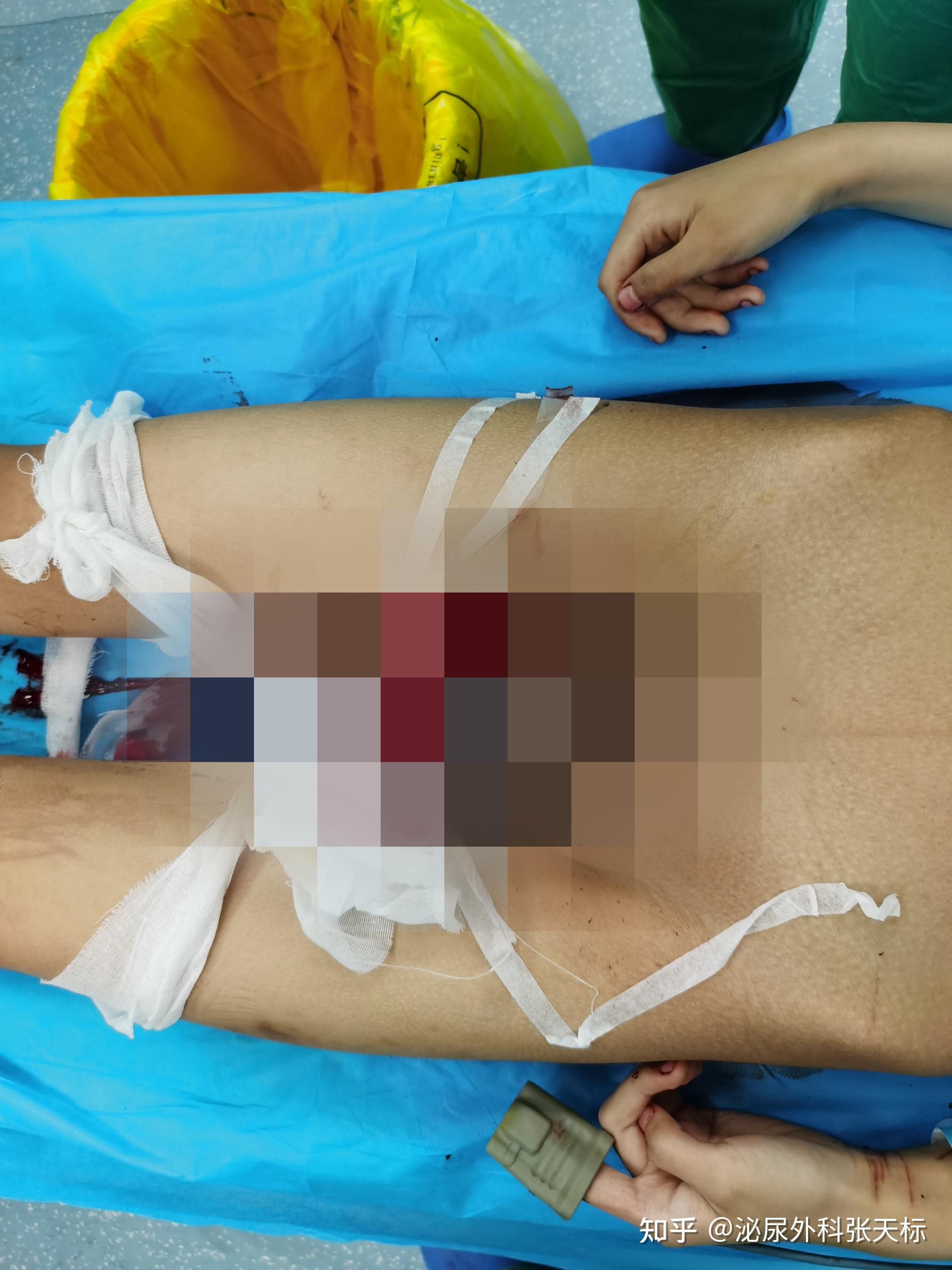 18岁小伙自宫切丁丁因觉得自己是女生