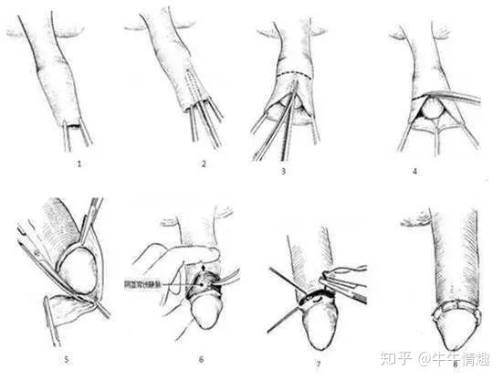 什么叫割礼 效果图图片