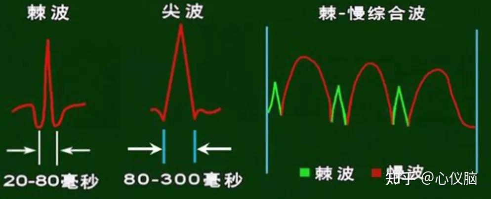 脑电图尖波和棘波图片图片