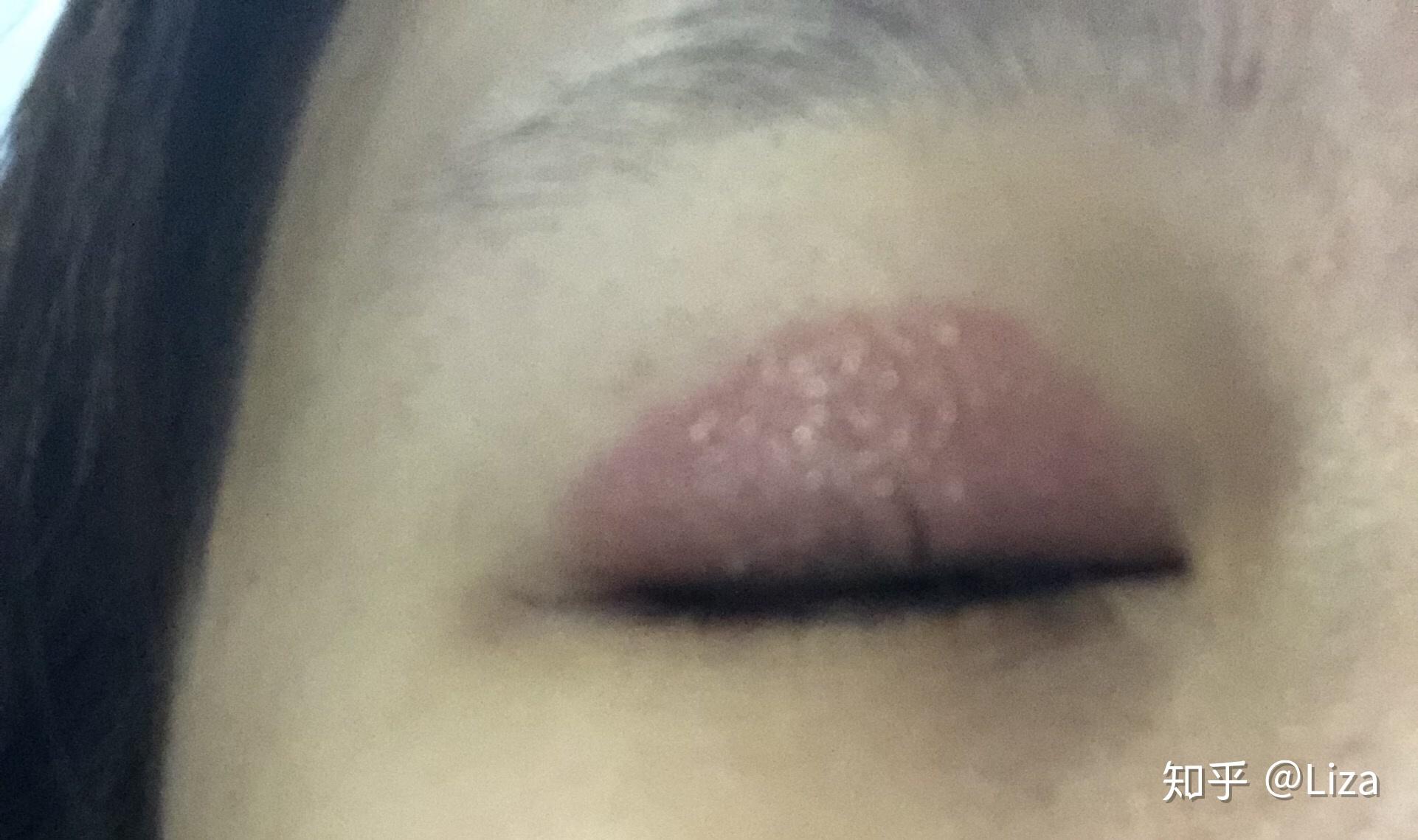 神经性皮炎 记录病情 - 知乎