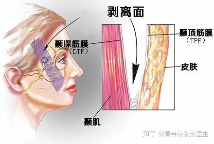 上眼皮下垂能用面部五层提升吗与额肌瓣手术相比哪个好