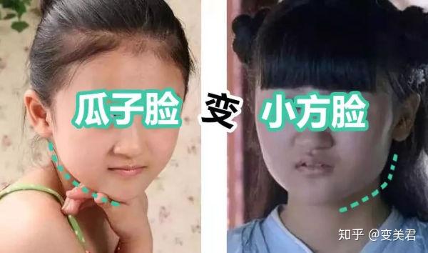 刘亦菲面部二次发育不削骨也越来越方所以颧骨和下颌骨真的会二次发育