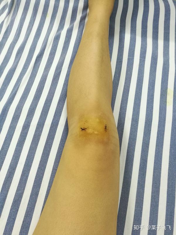 半月板缝合术后的prpprp治疗