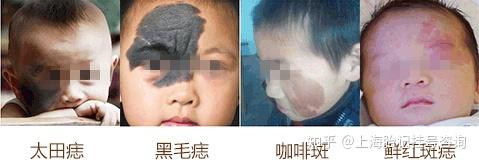 胎记有哪些颜色和类型 - 知乎