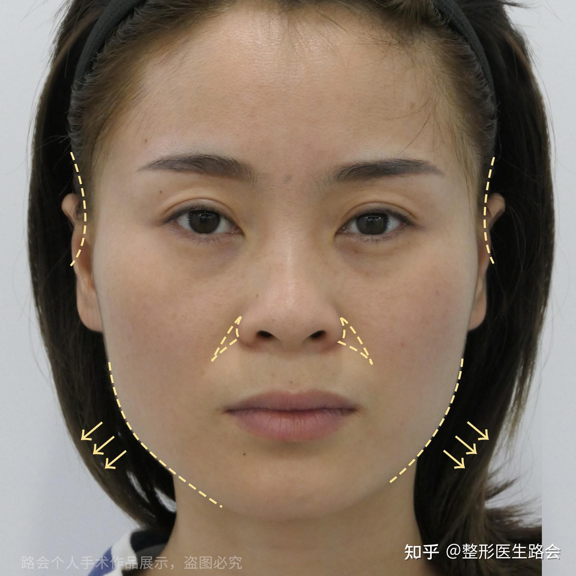 我的青春不一样35岁全脸整容术后10个月闺蜜说换了两张脸