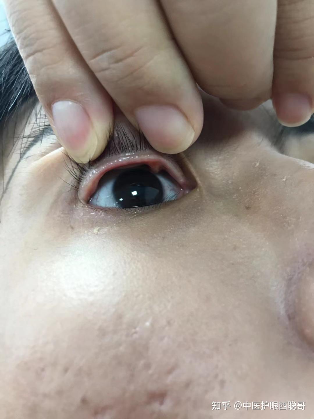 纯干货,重度干眼症救星!