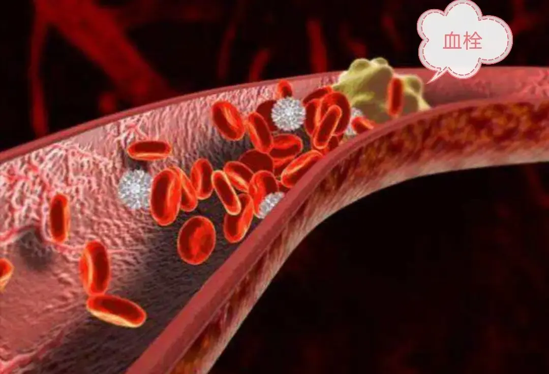 静脉血栓栓塞症,我该拿你怎么办? - 知乎