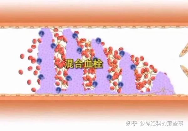 血栓形成的病理过程 - 知乎