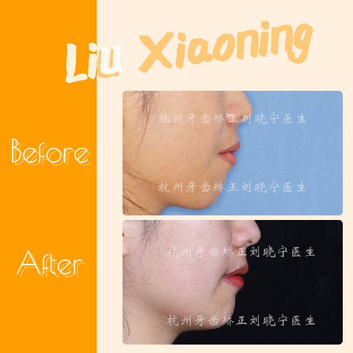 杭州牙齿矫正:告别微笑头号杀手露龈笑,姐就是女王! - 知乎