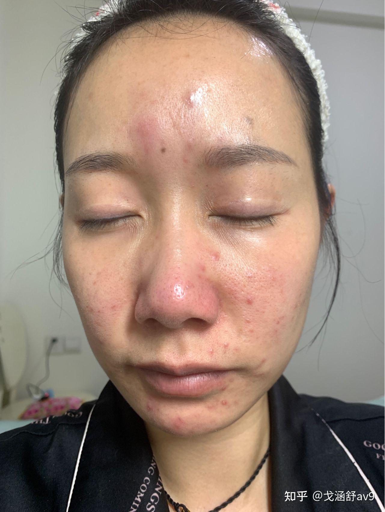 脸上有痘印怎么办？保姆级教程，轻松去除脸上痘印！ 知乎 0506