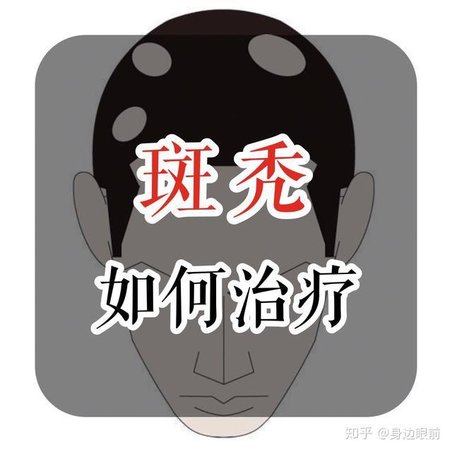 斑秃如何治疗?太原植发多少钱?
