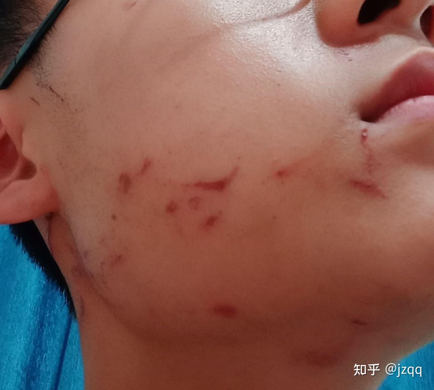 脸被抓伤了,在药物,生活习惯,饮食方面要注意什么