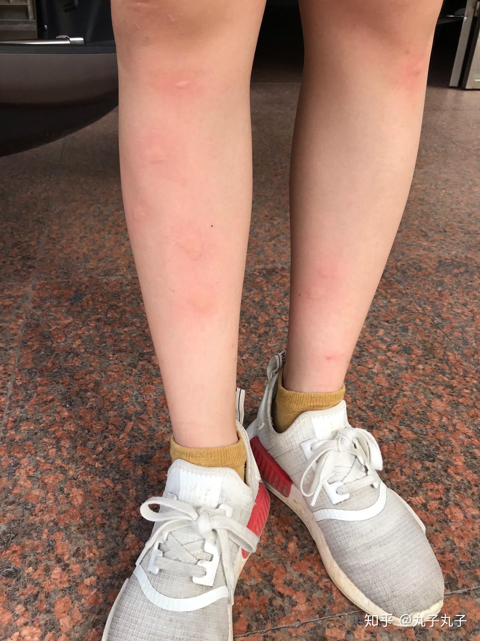 为什么有的人被蚊子咬后是起一个大包有的人则是出现一个红点