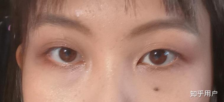 你怎么看待眼下痣?