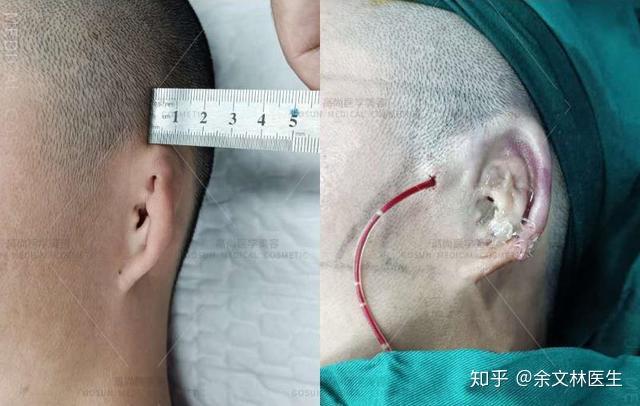 案例故事做完耳再造手术二期了终于可以摆脱自卑感