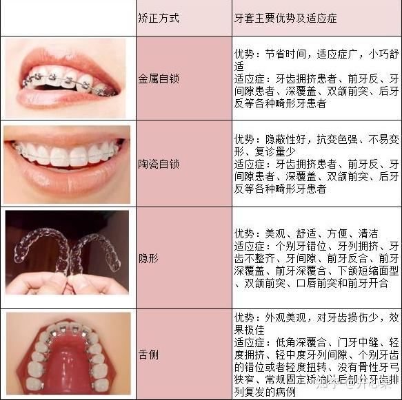 牙齿矫正的费用怎么收取的?真的很贵吗?