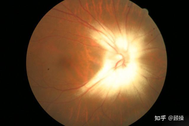 视网膜有髓神经纤维图片