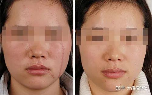身上有疤痕影响参军吗提醒明年计划参军入伍者祛疤需尽早