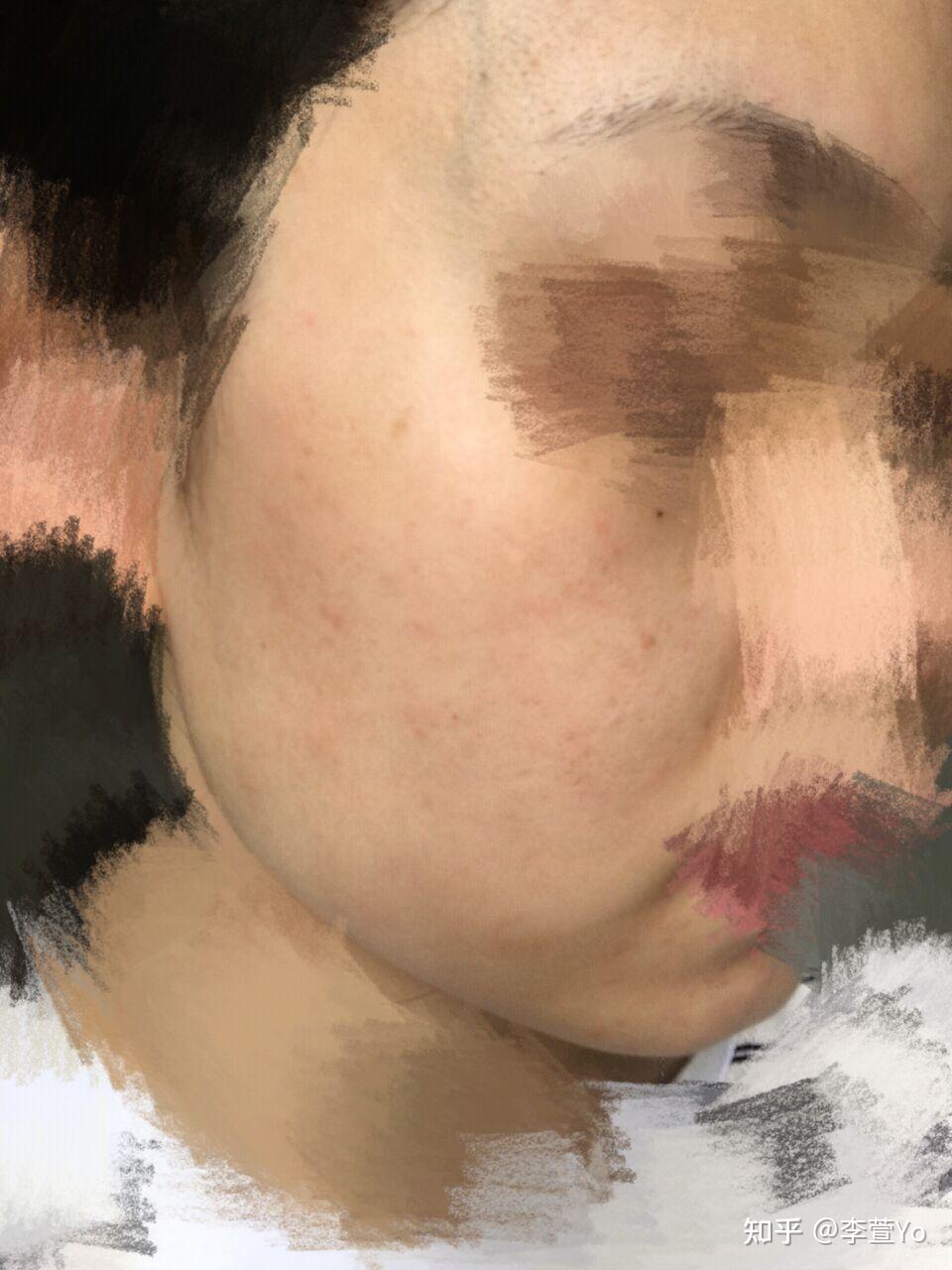 怎么去闭口? - 知乎