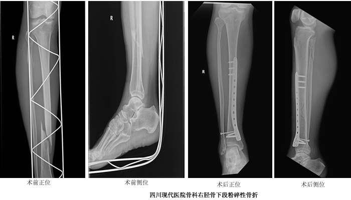 右胫骨下段粉碎性骨折 知乎 右胫骨下段粉碎性骨折 知乎